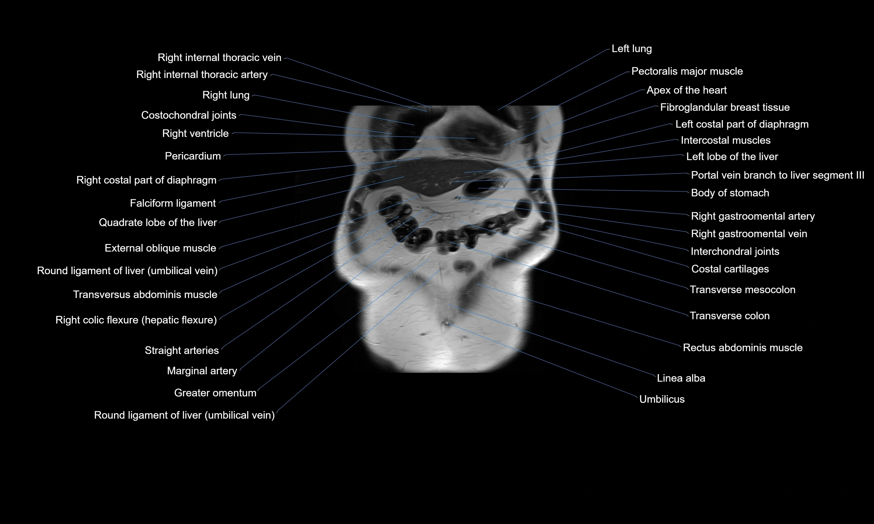 MRI Abdomen axial cross sectional anatomy radiology  image-img-00001-00011.webp